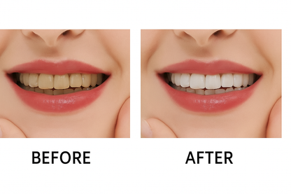 Blanqueador eléctrico en "U"